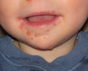hand foot mouth disease