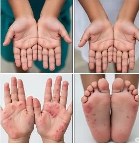 hand foot mouth disease