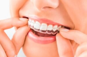 braces-treatment