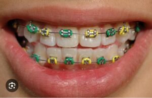 braces-treatment
