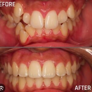 braces-treatment