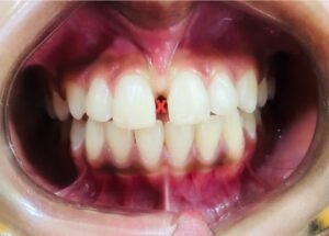 Dental treatment