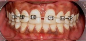 Dental treatment