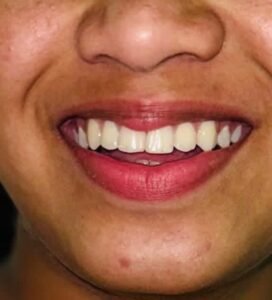 Dental treatment