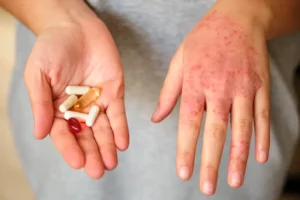 Drug poisoning