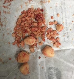 Urinary stones