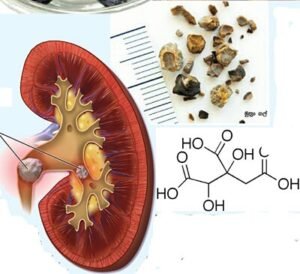 Urinary stones
