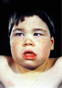 Thalassemia