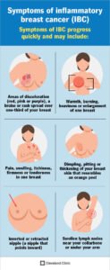 Breast cancer