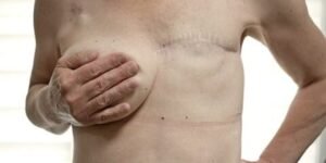 Breast cancer